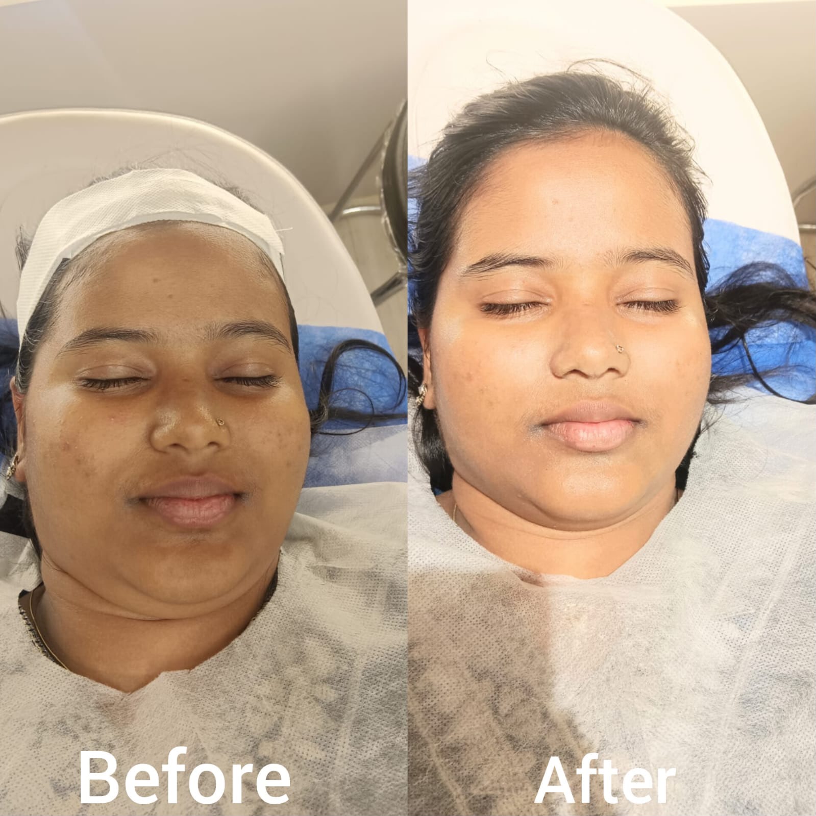 Skin brightening - Before and After treatment at Aura Clinic